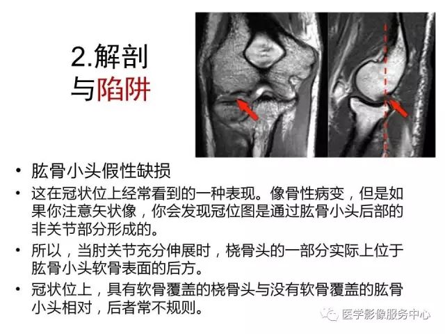 【PPT】肘关节MRI
