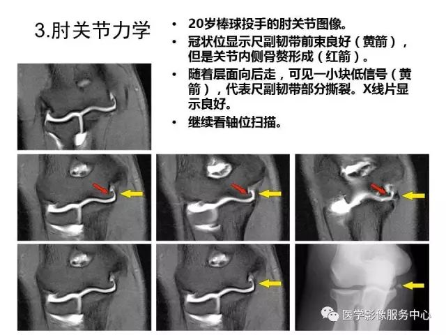 【PPT】肘关节MRI