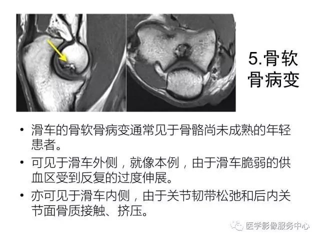 【PPT】肘关节MRI