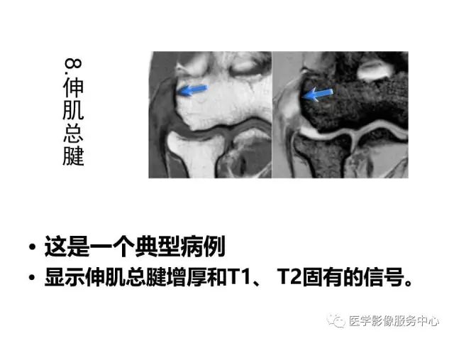 【PPT】肘关节MRI