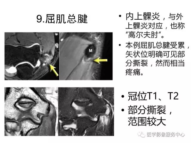 【PPT】肘关节MRI