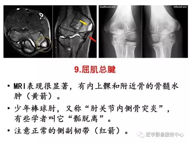 【PPT】肘关节MRI