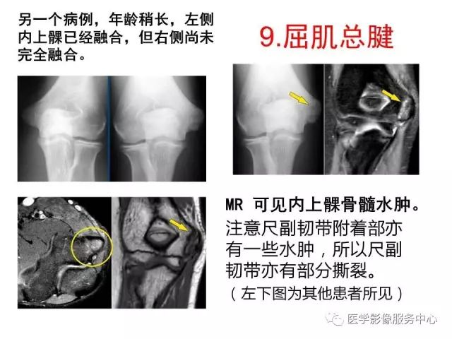 【PPT】肘关节MRI