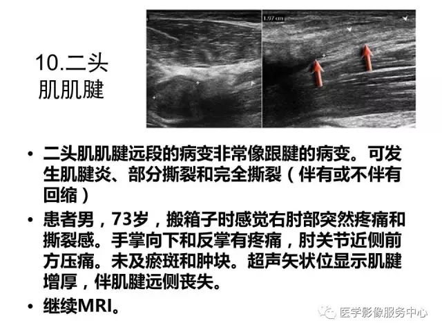 【PPT】肘关节MRI