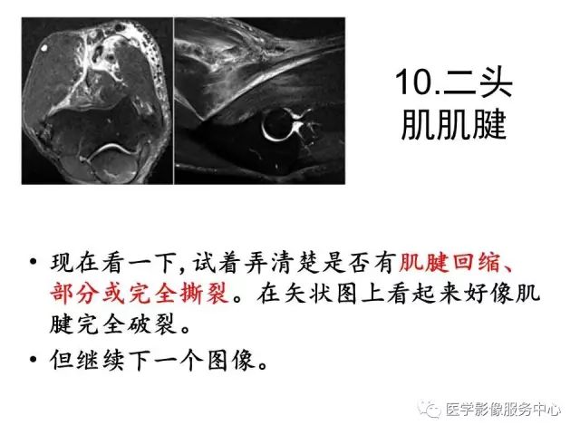 【PPT】肘关节MRI