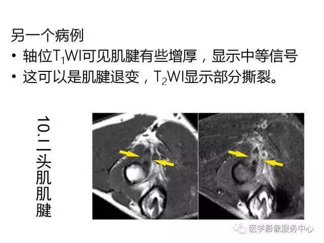 【PPT】肘关节MRI