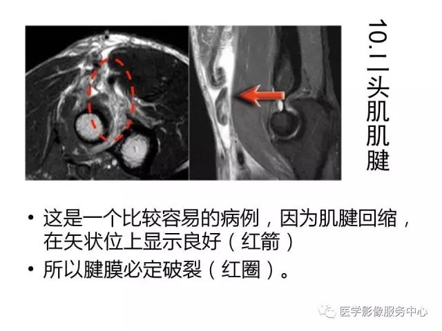 【PPT】肘关节MRI