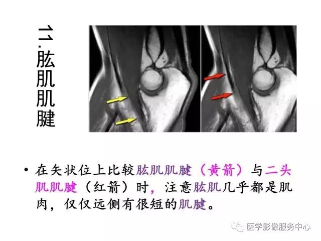 【PPT】肘关节MRI