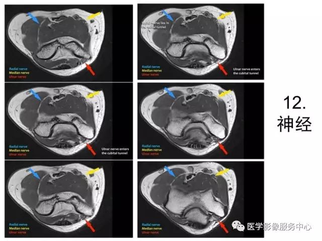 【PPT】肘关节MRI