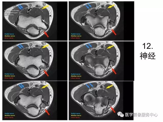 【PPT】肘关节MRI