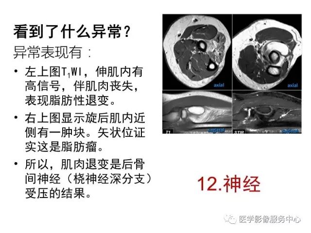 【PPT】肘关节MRI