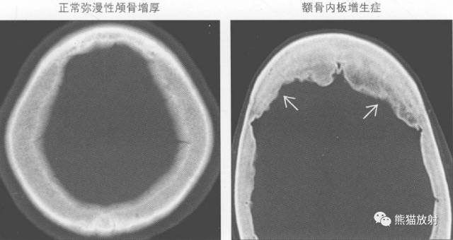 【书摘】弥漫性/局限性颅骨增厚的鉴别诊断