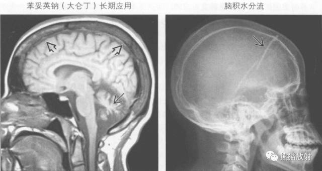 【书摘】弥漫性/局限性颅骨增厚的鉴别诊断