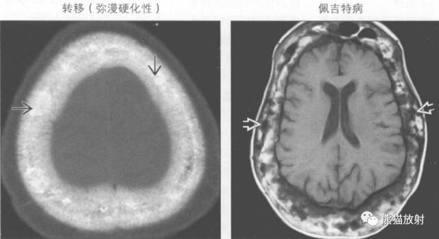 【书摘】弥漫性/局限性颅骨增厚的鉴别诊断