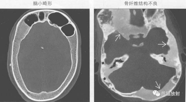 【书摘】弥漫性/局限性颅骨增厚的鉴别诊断