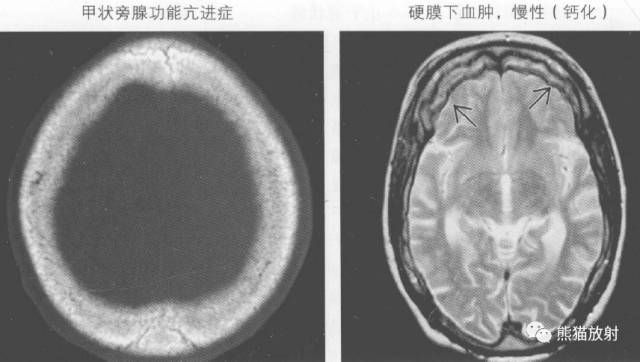 【书摘】弥漫性/局限性颅骨增厚的鉴别诊断
