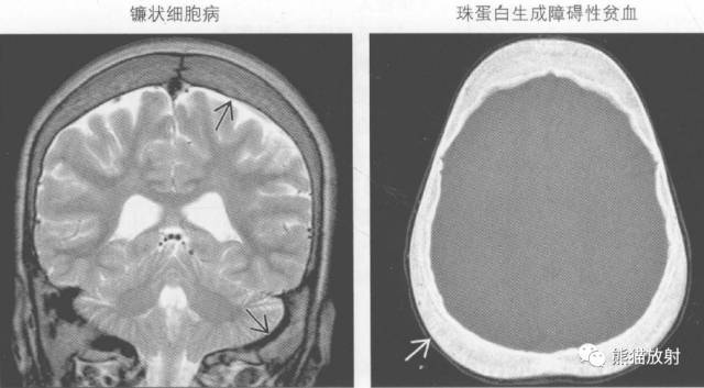 【书摘】弥漫性/局限性颅骨增厚的鉴别诊断