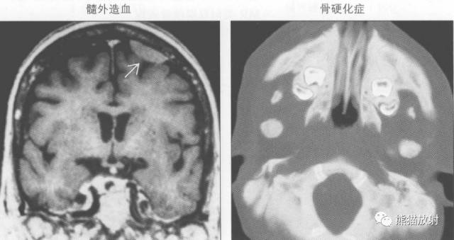 【书摘】弥漫性/局限性颅骨增厚的鉴别诊断