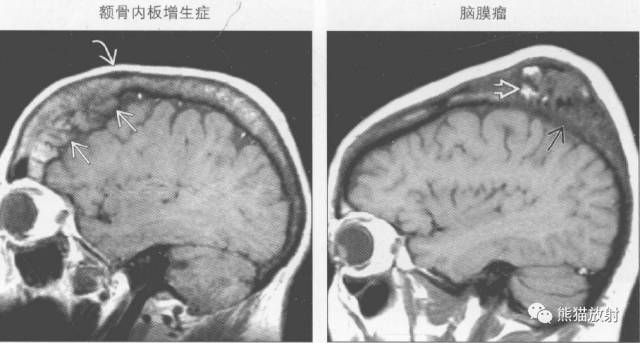 【书摘】弥漫性/局限性颅骨增厚的鉴别诊断