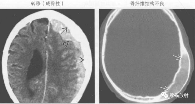 【书摘】弥漫性/局限性颅骨增厚的鉴别诊断