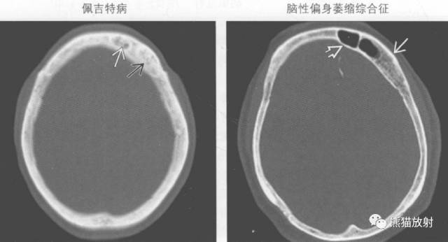【书摘】弥漫性/局限性颅骨增厚的鉴别诊断