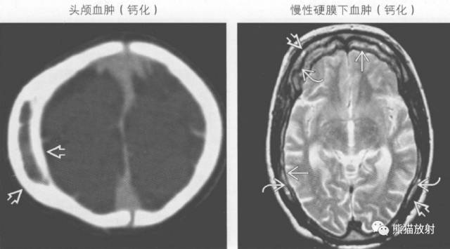 【书摘】弥漫性/局限性颅骨增厚的鉴别诊断