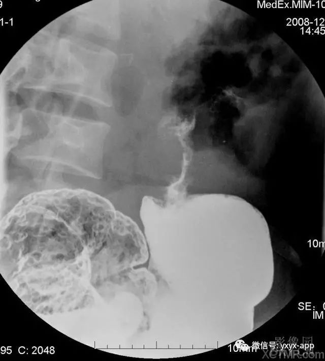 【病例】结肠息肉病并降结肠癌1例X线影像表现 【病例】结肠息肉病并降结肠癌1例X线影像表现