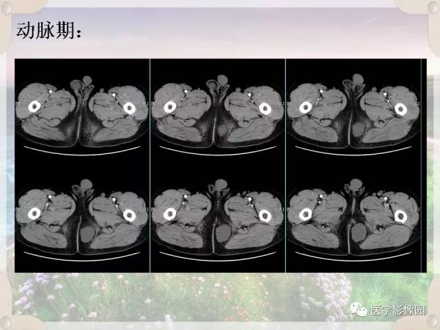 【病例】会阴部皮样囊肿1例CT影像表现