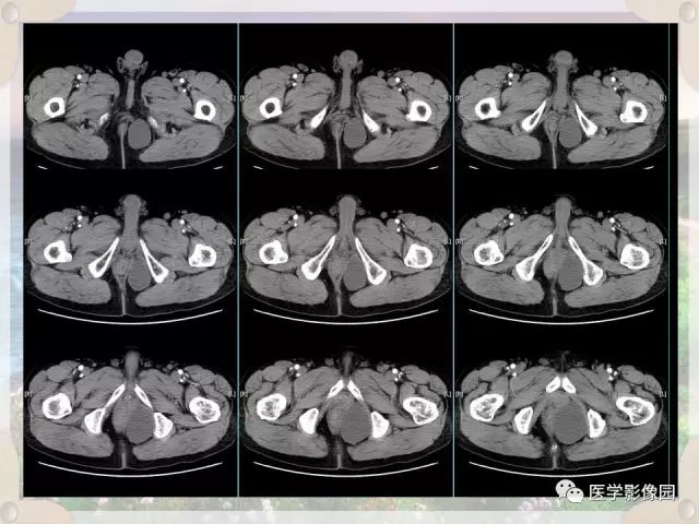 【病例】会阴部皮样囊肿1例CT影像表现