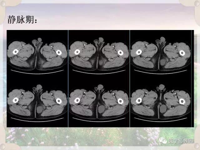 【病例】会阴部皮样囊肿1例CT影像表现