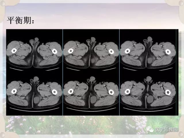 【病例】会阴部皮样囊肿1例CT影像表现