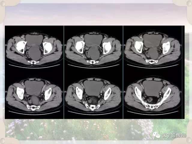 【病例】会阴部皮样囊肿1例CT影像表现