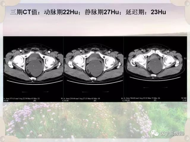 【病例】会阴部皮样囊肿1例CT影像表现