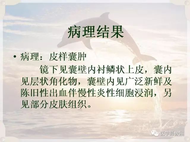 【病例】会阴部皮样囊肿1例CT影像表现