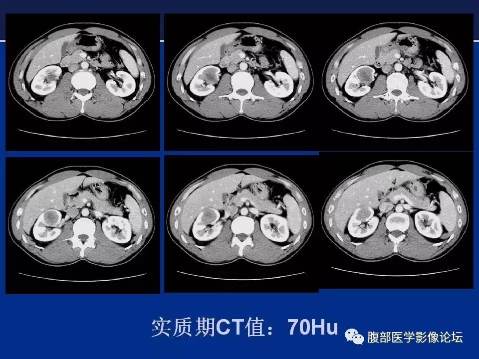 【病例】右侧后肾腺瘤1例CT及MR影像表现 【病例】右侧后肾腺瘤1例CT及MR影像表现