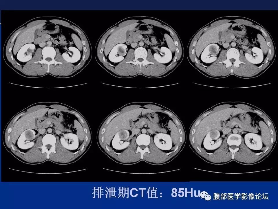 【病例】右侧后肾腺瘤1例CT及MR影像表现 【病例】右侧后肾腺瘤1例CT及MR影像表现