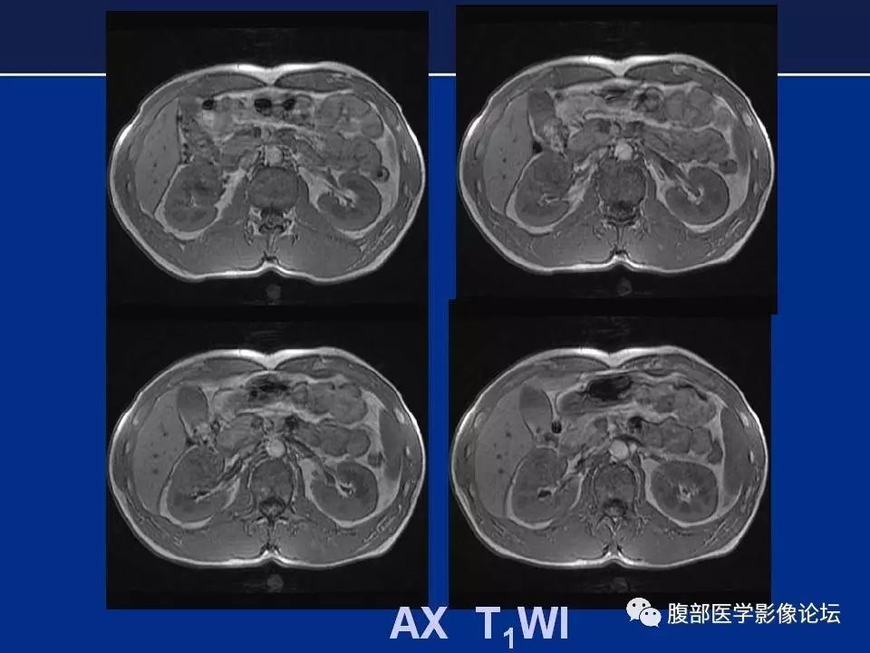 【病例】右侧后肾腺瘤1例CT及MR影像表现 【病例】右侧后肾腺瘤1例CT及MR影像表现