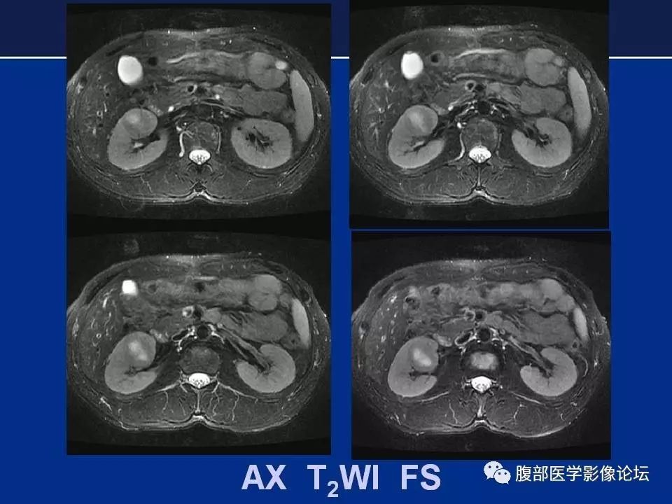 【病例】右侧后肾腺瘤1例CT及MR影像表现 【病例】右侧后肾腺瘤1例CT及MR影像表现