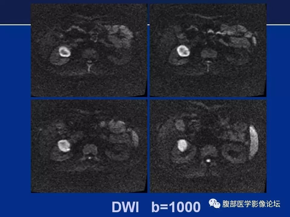 【病例】右侧后肾腺瘤1例CT及MR影像表现 【病例】右侧后肾腺瘤1例CT及MR影像表现