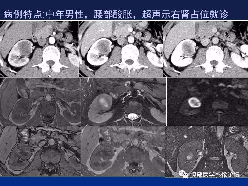 【病例】右侧后肾腺瘤1例CT及MR影像表现 【病例】右侧后肾腺瘤1例CT及MR影像表现