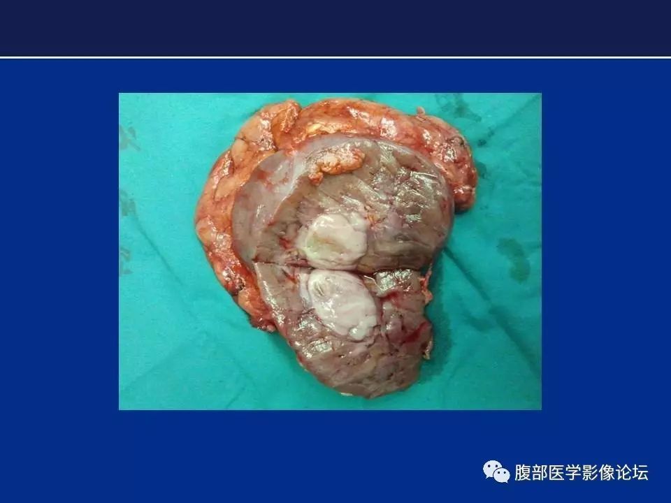 【病例】右侧后肾腺瘤1例CT及MR影像表现 【病例】右侧后肾腺瘤1例CT及MR影像表现
