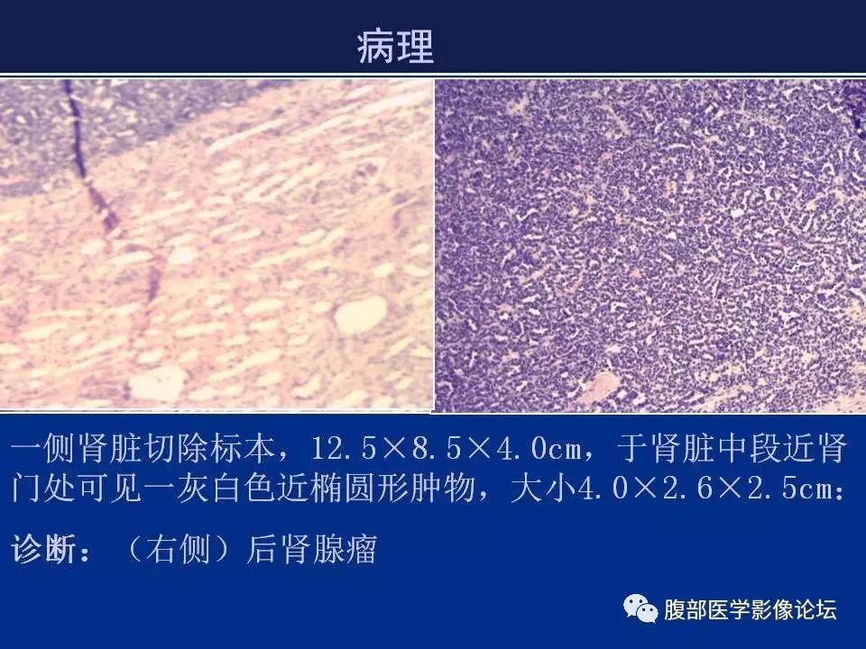 【病例】右侧后肾腺瘤1例CT及MR影像表现 【病例】右侧后肾腺瘤1例CT及MR影像表现