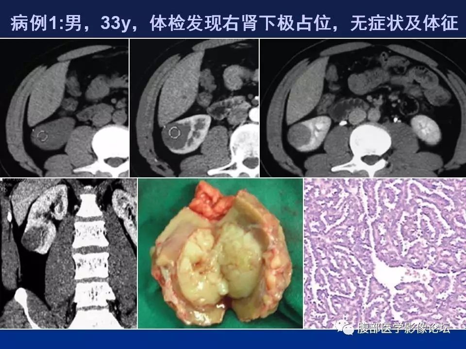 【病例】右侧后肾腺瘤1例CT及MR影像表现 【病例】右侧后肾腺瘤1例CT及MR影像表现