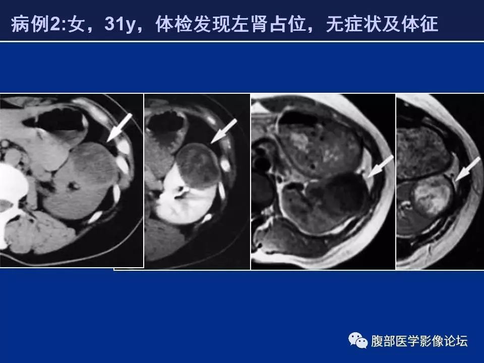 【病例】右侧后肾腺瘤1例CT及MR影像表现 【病例】右侧后肾腺瘤1例CT及MR影像表现
