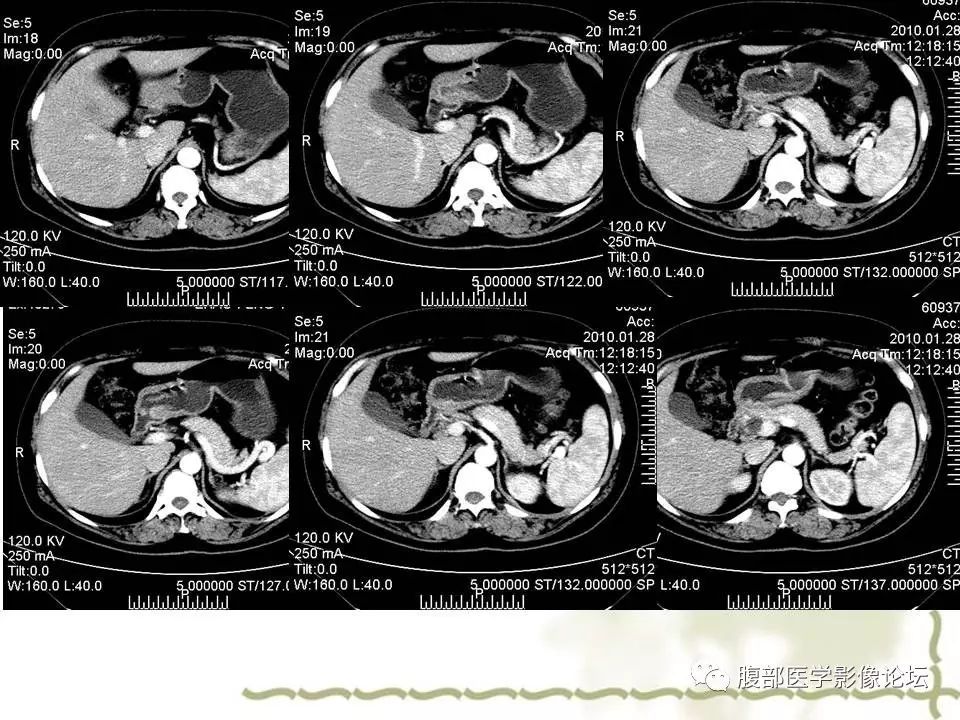 【病例】胰头浆液性囊腺瘤1例CT及MR 【病例】胰头浆液性囊腺瘤1例CT及MR