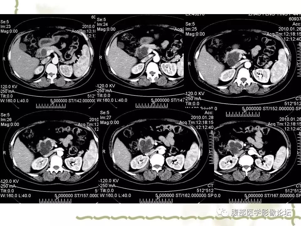 【病例】胰头浆液性囊腺瘤1例CT及MR 【病例】胰头浆液性囊腺瘤1例CT及MR