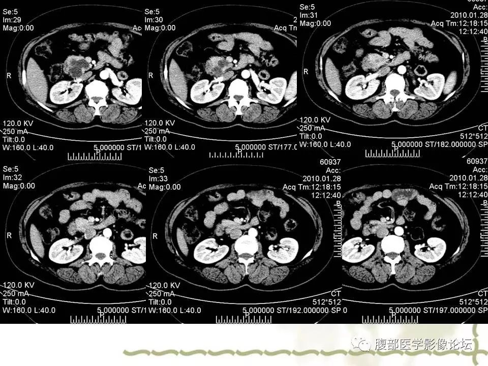【病例】胰头浆液性囊腺瘤1例CT及MR 【病例】胰头浆液性囊腺瘤1例CT及MR