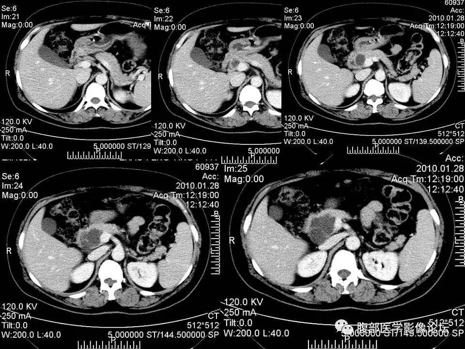 【病例】胰头浆液性囊腺瘤1例CT及MR 【病例】胰头浆液性囊腺瘤1例CT及MR