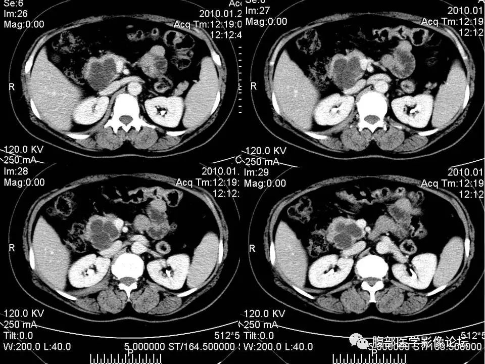 【病例】胰头浆液性囊腺瘤1例CT及MR 【病例】胰头浆液性囊腺瘤1例CT及MR