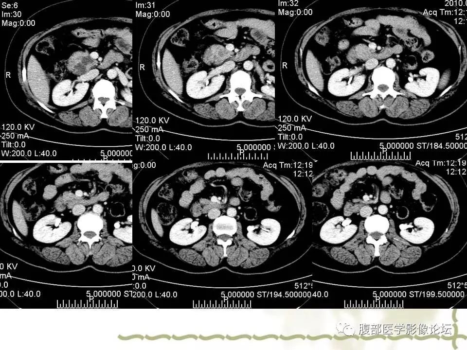 【病例】胰头浆液性囊腺瘤1例CT及MR 【病例】胰头浆液性囊腺瘤1例CT及MR